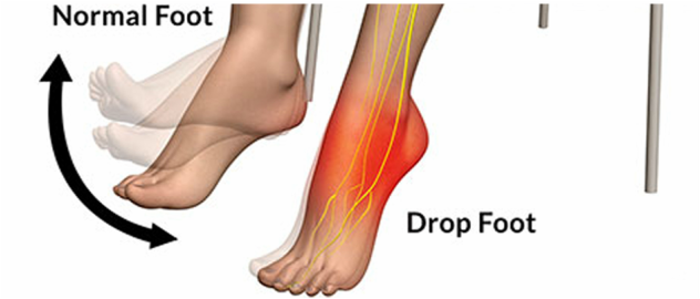 What is Foot Drop or Injection Palsy? – PhysioCraft