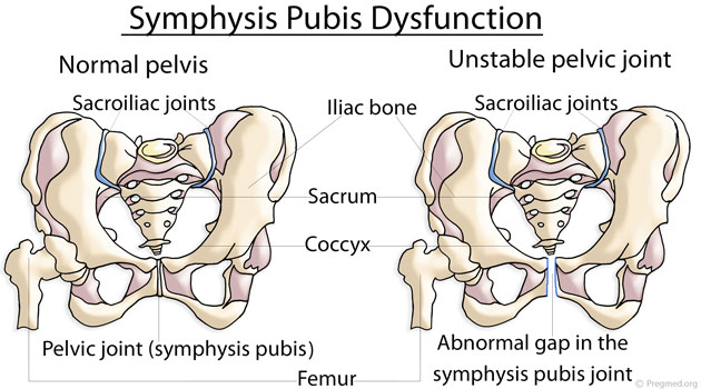 Symphysis Pubis Dysfunction, Pelvis pain and Chiropractic - Indian  Chiropractic