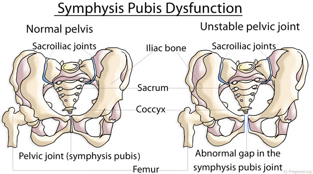 Symphysis Pubis Dysfunction - Pelvis - Conditions